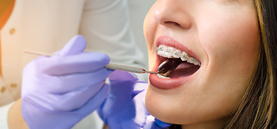 Keith Nelson Family Dentist Orthodontics Ponsonby Fixed Braces